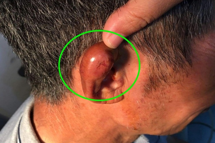 耳廓软骨膜炎包块图