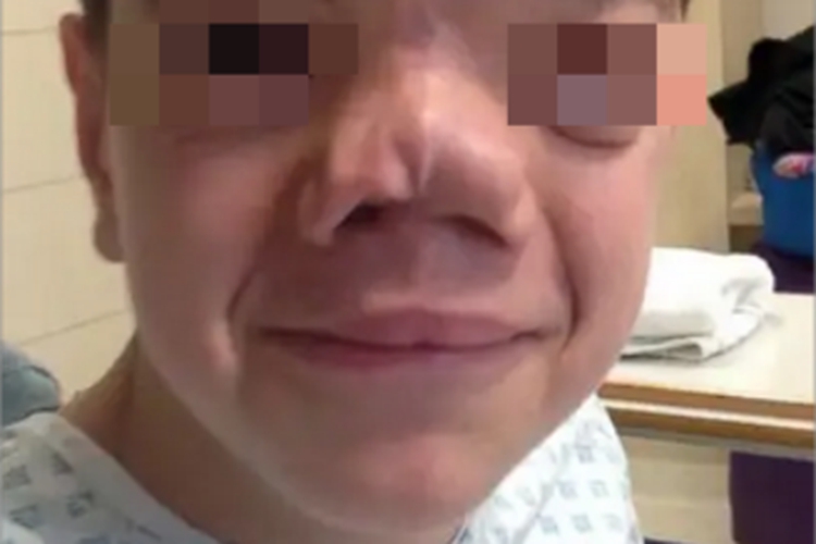 先天性鼻侧裂鼻部畸形图 先天性鼻侧裂鼻部畸形图