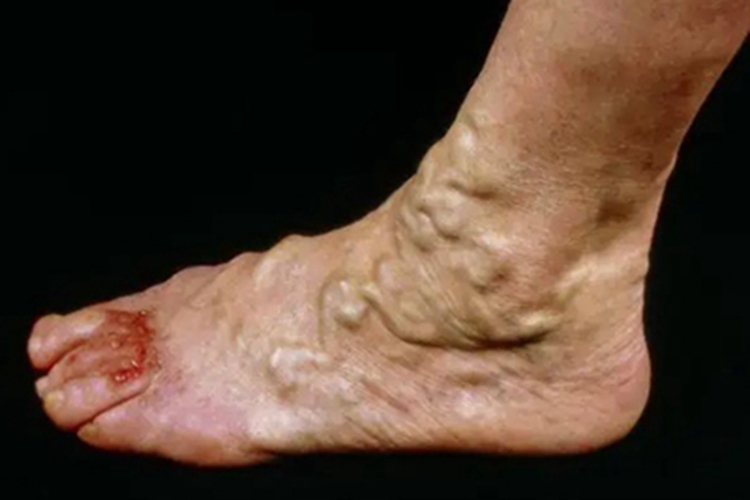 游走性血栓性静脉炎脚部症状图 游走性血栓性静脉炎脚部症状图