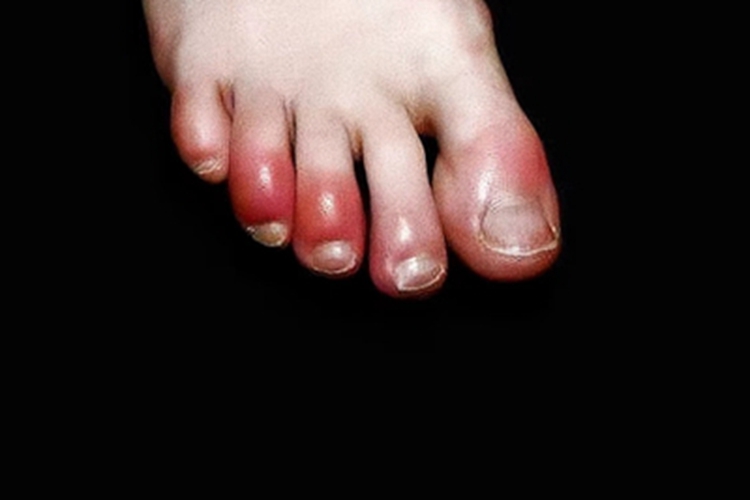 浸渍足脚趾肿胀发红图 浸渍足脚趾肿胀发红图