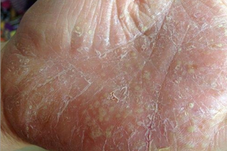 手浅表性大疱性脓皮病脱屑图