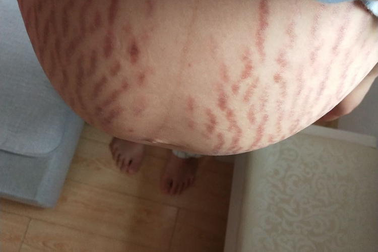 妊娠纹腹部有褐色纹路图