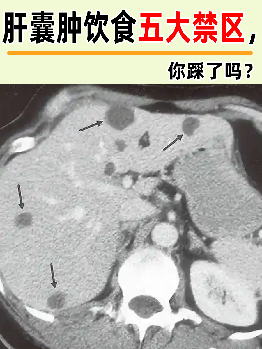 肝囊肿饮食五大禁区，你踩了吗？