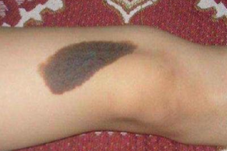 浅表播散型黑色素瘤黑斑图