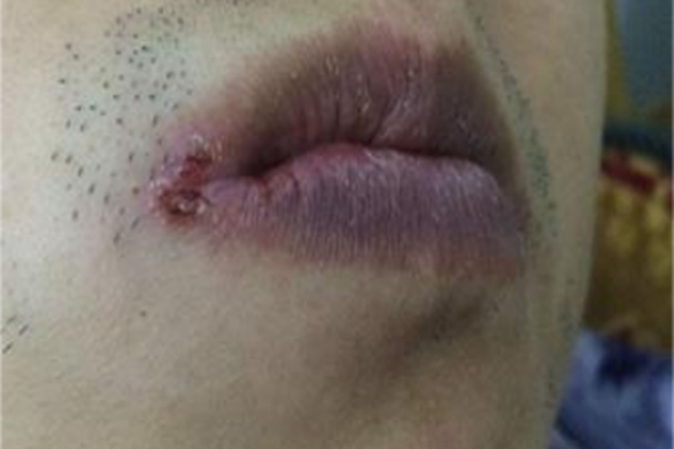 感染性口角炎嘴唇血痂图 感染性口角炎嘴唇血痂图