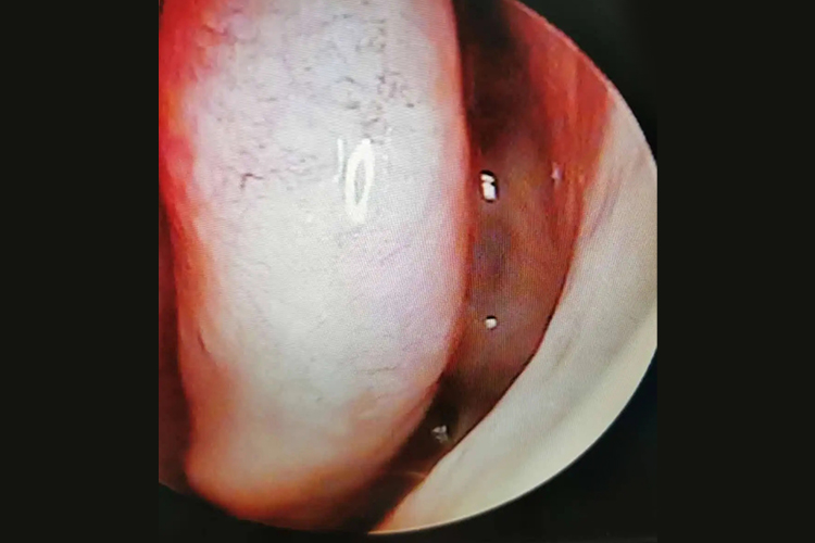 颈源性鼻炎图 颈源性鼻炎图