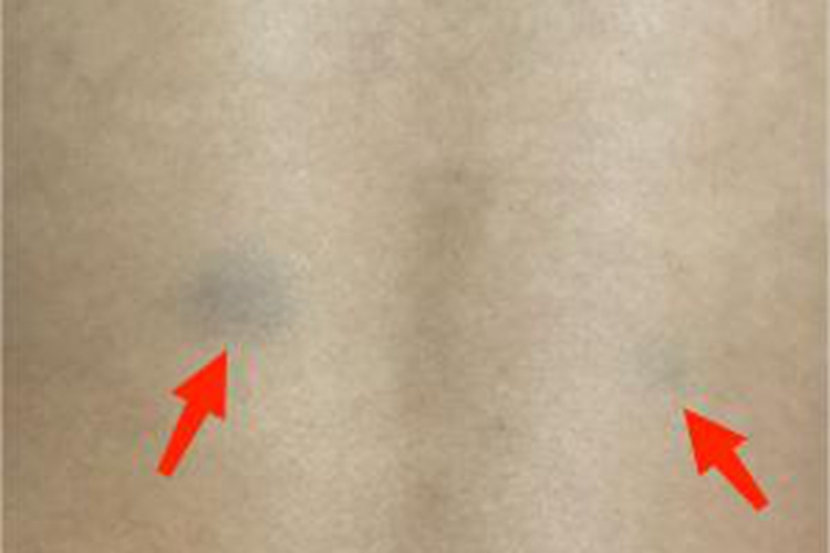 瘀斑背部青色小斑块图