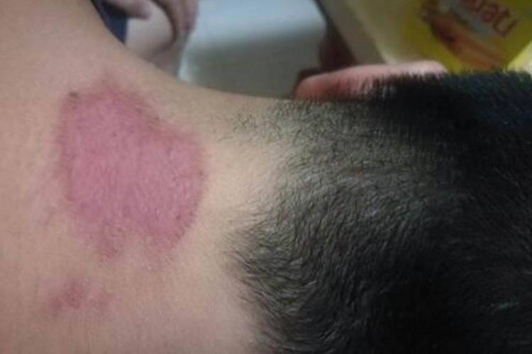 Ⅰ度烧伤后颈症状图 Ⅰ度烧伤后颈症状图