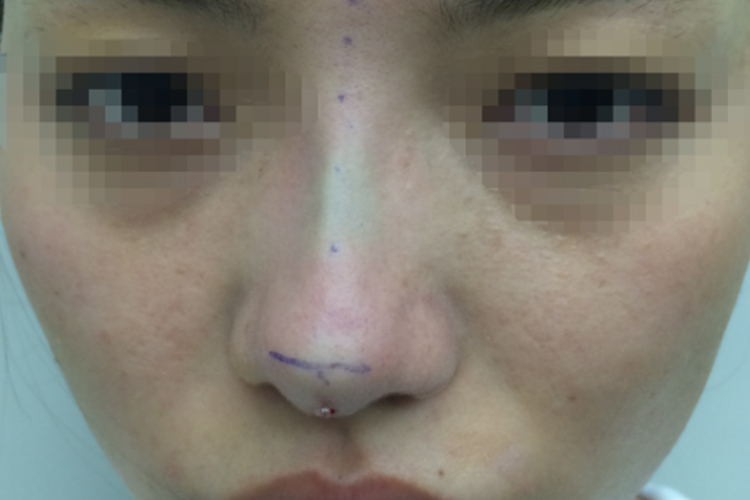 肋骨隆鼻后肿胀图 肋骨隆鼻后肿胀图