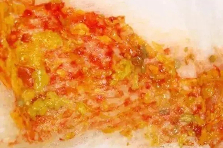 4个月宝宝细菌性痢疾大便图