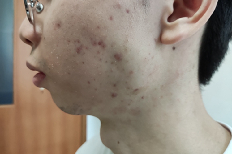 痤疮面部脱屑图