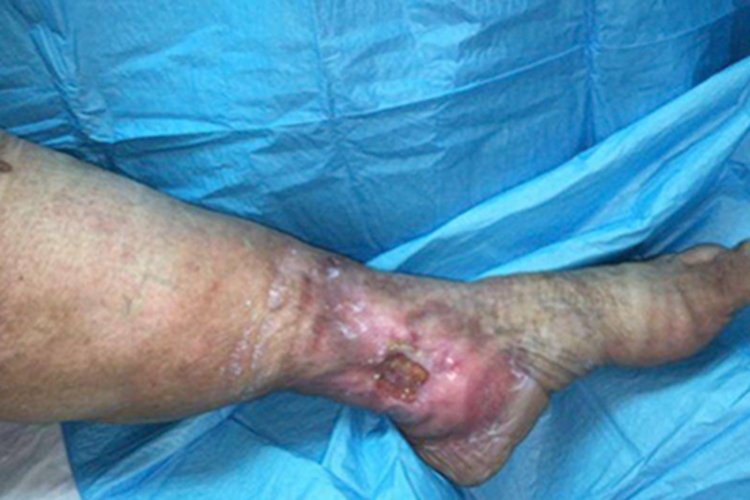 静脉曲张性溃疡脚踝红肿溃疡图