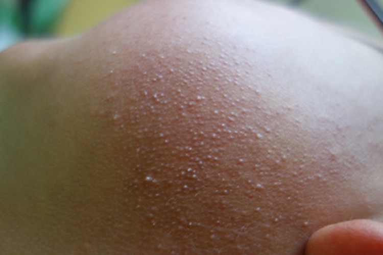 毛发苔藓面部小疙瘩图