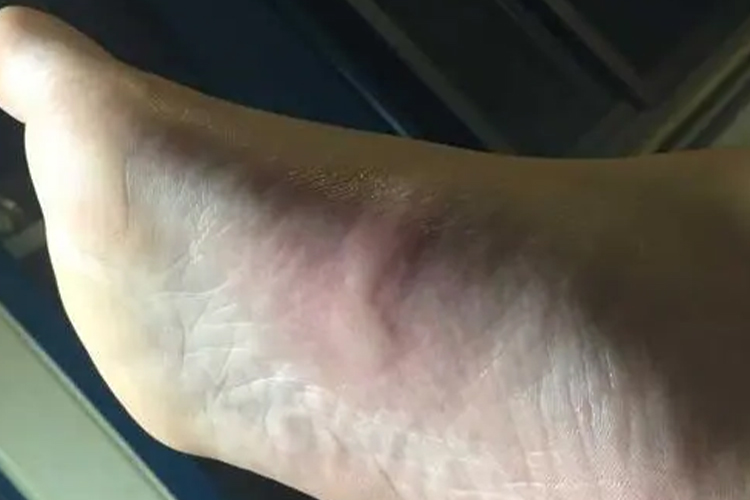 脚底蚊虫叮咬图