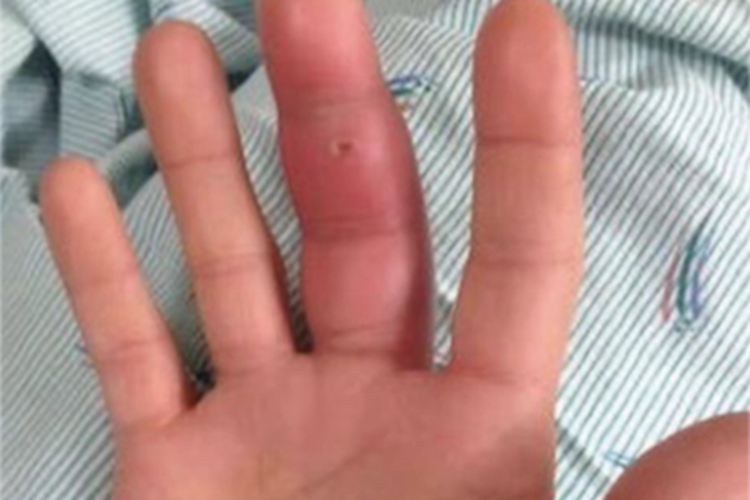 夹伤右手中指红肿发胀图 夹伤右手中指红肿发胀图