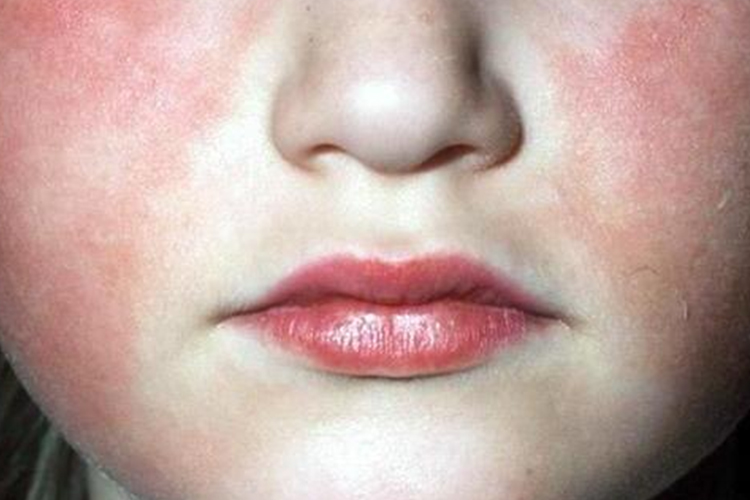 儿童猩红热早期口周苍白圈图