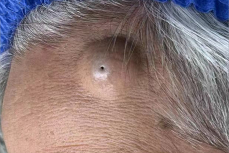 毛根鞘囊肿前额症状图