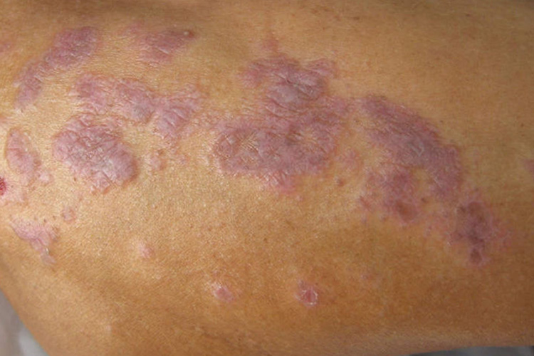 扁平苔藓图 扁平苔藓图