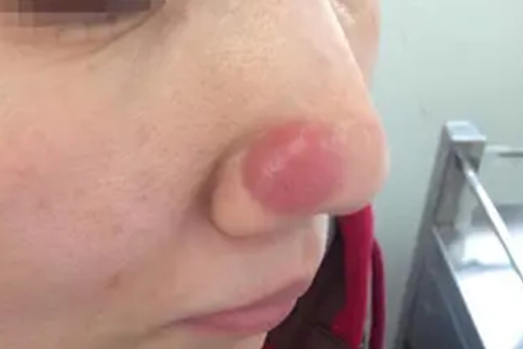 鼻子上有红色纤维瘤图 鼻子上有红色纤维瘤图