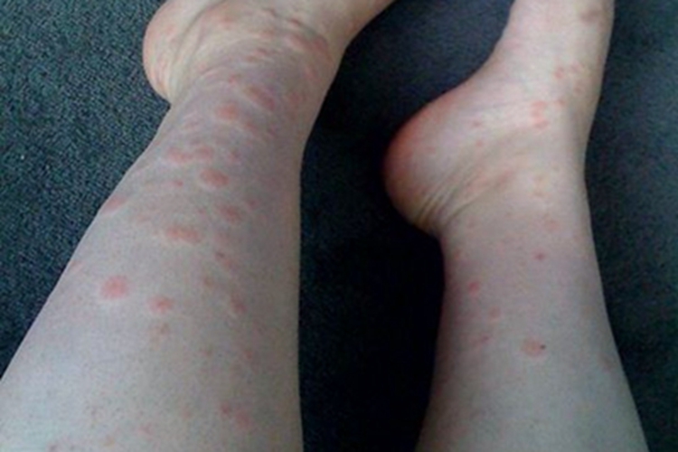 恙螨皮炎小腿风团图