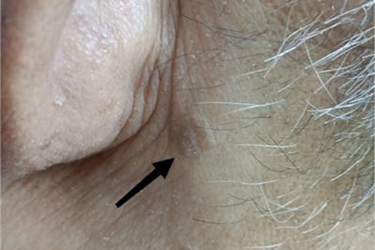 扁平疣耳后症状图 扁平疣耳后症状图