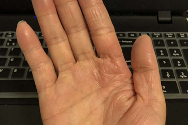 遗传性掌跖角化病条纹图