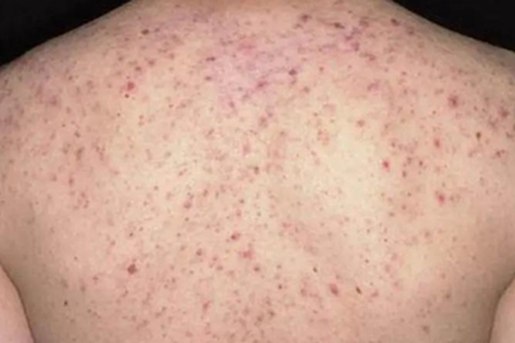 痤疮背部长好多小疙瘩留黑点图