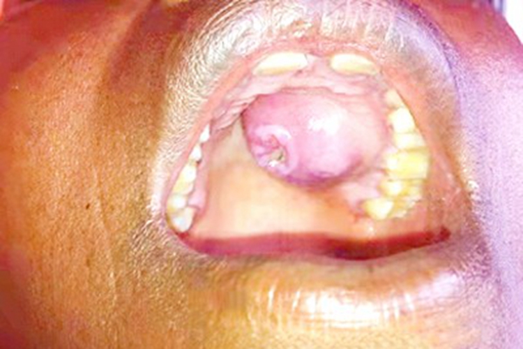 颌面部获得性梅毒口腔大疙瘩图 颌面部获得性梅毒口腔大疙瘩图