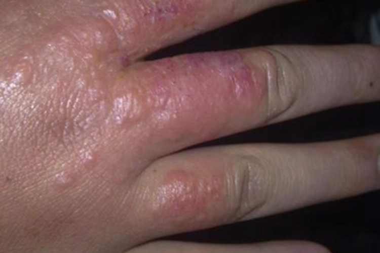 冻疮手部结节斑块图