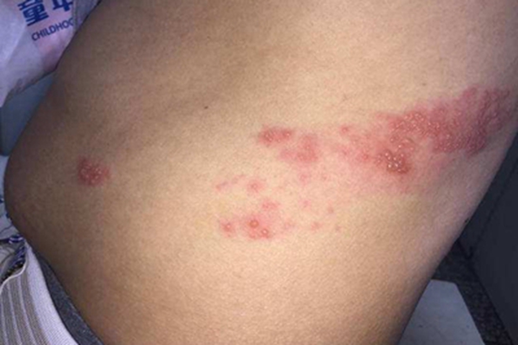 柯萨奇湿疹腰部侧面水疱图