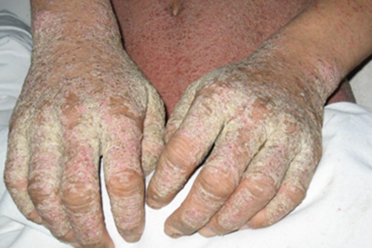 结痂性疥疮手背结黄痂图