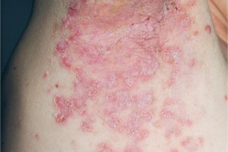 家族性良性慢性天疱疮腋窝症状图