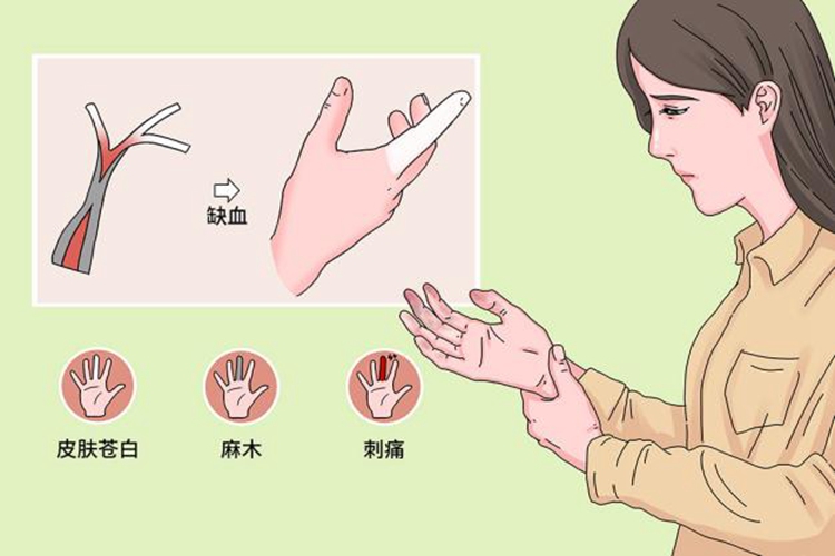 雷诺氏综合征症状图