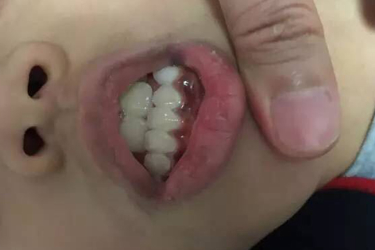 重金属色素沉着牙床发黑图