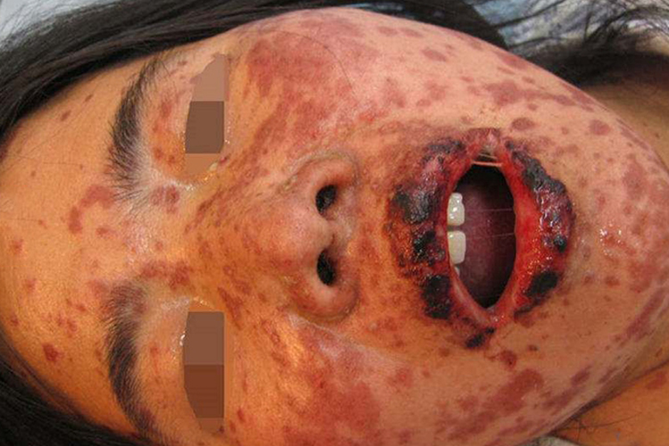 重症型多形红斑图