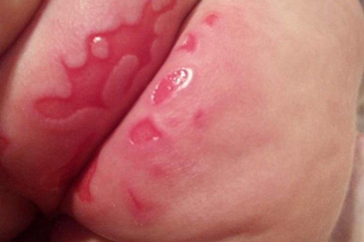 尿布皮炎臀部发白表面脱皮图