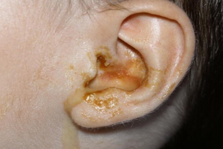 急性化脓性中耳炎耳部渗液图