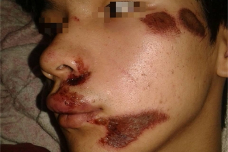 擦伤面部结痂图