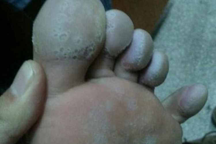 足癣脚趾小坑图 足癣脚趾小坑图