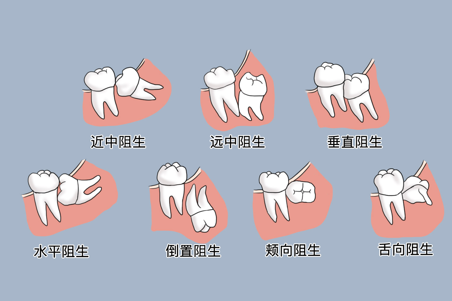 最难拔的智齿图