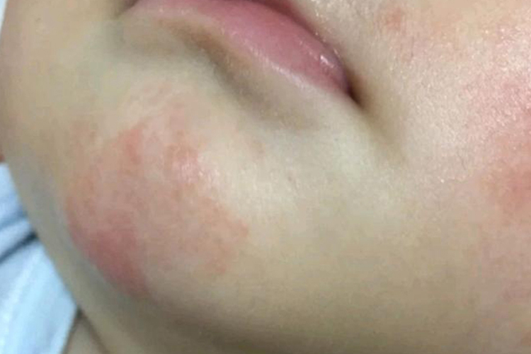 四个月宝宝下巴口水疹图