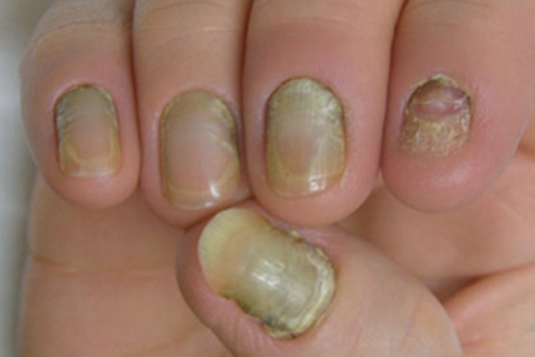 黄甲综合征手指甲症状图