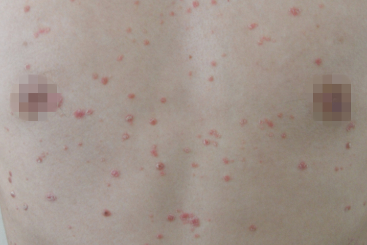 点滴状银屑病图