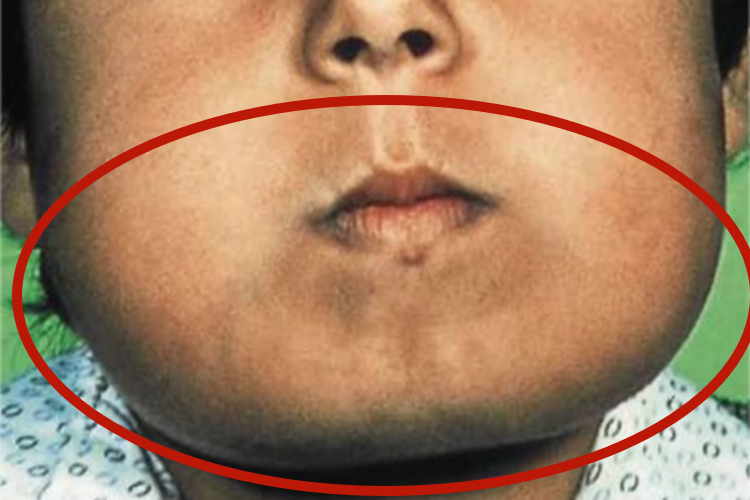 巨颌症面颊肿图 巨颌症面颊肿图