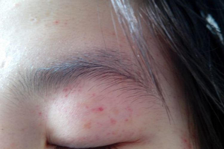 孩子眼睛周围外伤出血点图