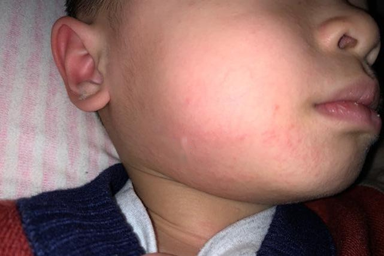 马齿苋过敏皮疹图