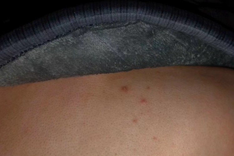 毛囊炎背部散在几个丘疹图 毛囊炎背部散在几个丘疹图