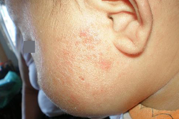 幼儿湿疹型药疹图