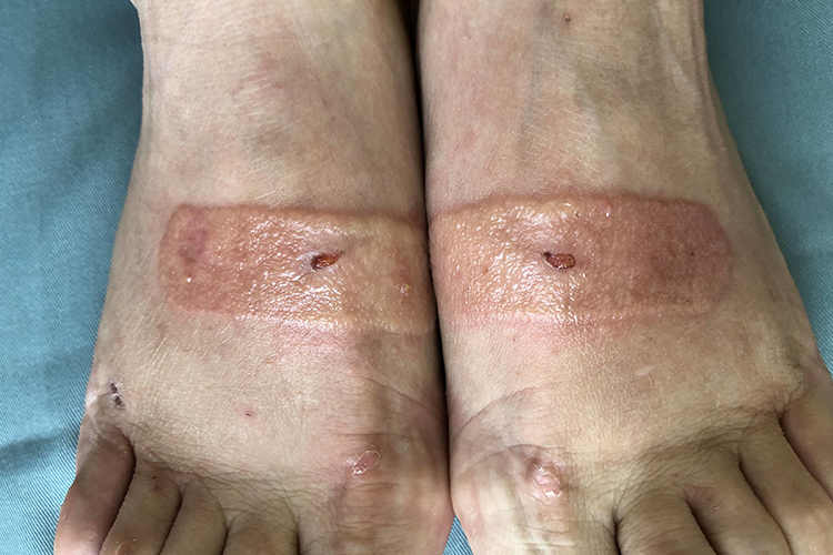 急性接触性皮炎皮损图