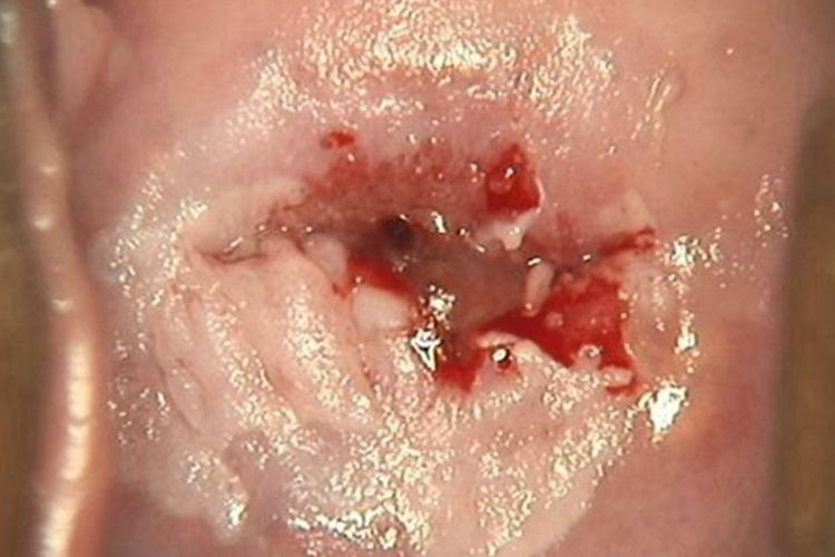 宫颈癌轻度出血宫颈图 宫颈癌轻度出血宫颈图